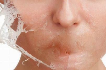 Cildine bunu yapanlar yandı! Cildiniz yanabilir...